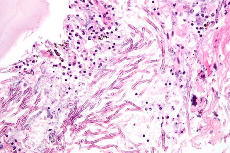 Onddoek sistema immunologikoa apurtzen dute eta mikosiak sortzen dituzte
