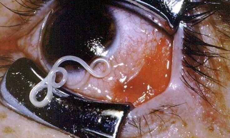 parasitoa giza begietan